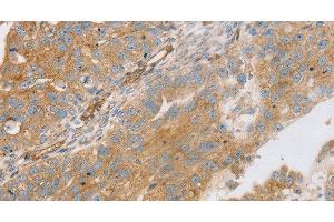 Immunohistochemistry of paraffin-embedded Human breast cancer using STX16 Polyclonal Antibody at dilution of 1:30 (Syntaxin 16 antibody)