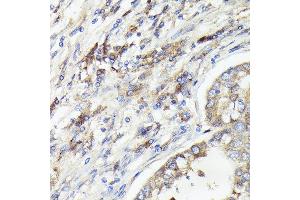 Immunohistochemistry of paraffin-embedded human lung cancer using IL1A Rabbit pAb (ABIN6129280, ABIN6142331, ABIN6142332 and ABIN6217051) at dilution of 1:100 (40x lens). (IL1A antibody  (AA 112-271))