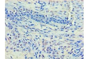 Immunohistochemistry of paraffin-embedded human breast cancer using ABIN7155327 at dilution of 1:100 (HDAC8 antibody  (AA 1-377))