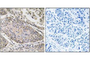 Immunohistochemistry analysis of paraffin-embedded human lung carcinoma tissue using PLA2G4E antibody. (PLA2G4E antibody)