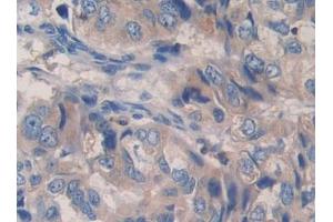 Used in DAB staining on fromalin fixed paraffin- embedded liver cancer tissue (PCSK9 antibody  (AA 454-679))