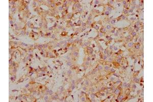IHC image of ABIN7127380 diluted at 1:118 and staining in paraffin-embedded human liver cancer performed on a Leica BondTM system. (Recombinant CA9 antibody)