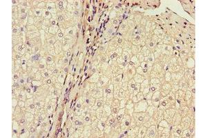 Immunohistochemistry of paraffin-embedded human liver cancer using ABIN7159937 at dilution of 1:100 (BRP44 antibody  (AA 1-40))