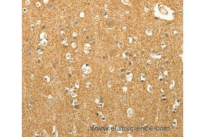 Immunohistochemistry of Human liver cancer using LPAR3 Polyclonal Antibody at dilution of 1:40