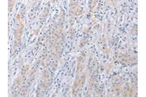 The image on the left is immunohistochemistry of paraffin-embedded Human gastric cancer tissue using ABIN7131038(SERPINE2 Antibody) at dilution 1/20, on the right is treated with fusion protein. (SERPINE2 antibody)