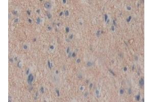 Detection of ENPEP in Human Glioma Tissue using Polyclonal Antibody to Aminopeptidase A (ENPEP) (ENPEP antibody  (AA 718-948))