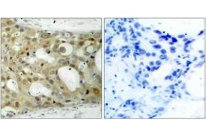 Immunohistochemistry analysis of paraffin-embedded human breast carcinoma tissue, using BCL-2 (Ab-70) Antibody. (Bcl-2 antibody  (AA 41-90))