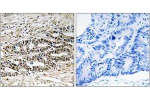 Immunohistochemistry analysis of paraffin-embedded human colon carcinoma tissue, using MDM4 (Ab-367) Antibody.