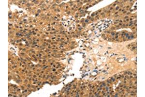 The image on the left is immunohistochemistry of paraffin-embedded Human breast cancer tissue using ABIN7191443(MED14 Antibody) at dilution 1/20, on the right is treated with synthetic peptide. (MED14 antibody)