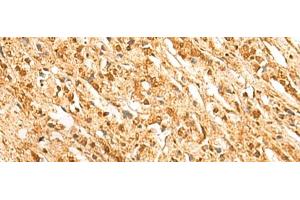 Immunohistochemistry of paraffin-embedded Human prost ate cancer tissue using SSSCA1 Polyclonal Antibody at dilution of 1:50(x200) (SSSCA1 antibody)