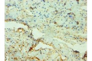 Immunohistochemistry of paraffin-embedded human cervical cancer using ABIN7169180 at dilution of 1:100 (SGK3 antibody  (AA 1-150))