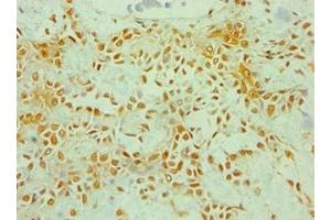 Immunohistochemistry of paraffin-embedded human breast cancer using ABIN7176253 at dilution of 1:100 (ZNF346 antibody  (AA 1-294))