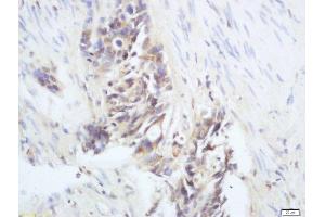 Formalin-fixed and paraffin embedded human colon cancer labeled with Anti-phospho-RAC1(Ser71) Polyclonal Antibody, Unconjugated  at 1:200 followed by conjugation to the secondary antibody and DAB staining (RAC1 antibody  (pSer71))