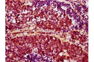 IHC image of ABIN7127677 diluted at 1:100 and staining in paraffin-embedded human lung cancer performed on a Leica BondTM system. (Recombinant AKT1 antibody  (pSer473))