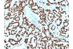 IHC testing of FFPE human prostate carcinoma with FOXA1 antibody (clone FOXA1/1518). (FOXA1 antibody  (AA 372-472))