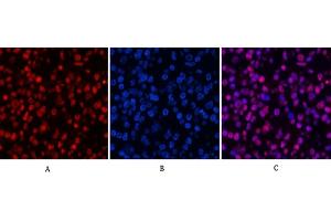 Immunofluorescence analysis of human lung cancer tissue. (Histone 3 antibody  (acLys9))