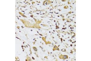 Immunohistochemistry of paraffin-embedded human liver cancer using GPD2 Antibody (ABIN5973974) at dilution of 1/100 (40x lens). (GPD2 antibody)