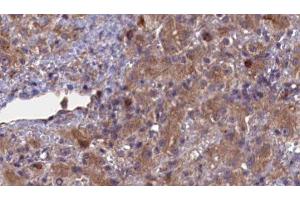 ABIN6276936 at 1/100 staining Human liver cancer tissue by IHC-P. (ABCG8 antibody  (Internal Region))