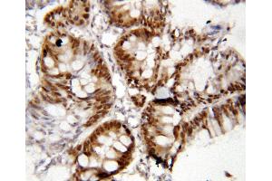 Anti-FOXP1 antibody, IHC(P) IHC(P): Human Rectal Cancer Tissue (FOXP1 antibody  (C-Term))