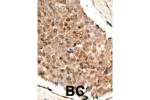 Formalin-fixed and paraffin-embedded human cancer tissue reacted with the primary antibody, which was peroxidase-conjugated to the secondary antibody, followed by DAB staining. (BMP10 antibody  (N-Term))