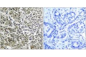 Immunohistochemistry analysis of paraffin-embedded human prostate carcinoma tissue, using Androgen Receptor (Ab-650) Antibody.