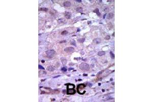Formalin-fixed and paraffin-embedded human cancer tissue reacted with RET polyclonal antibody  , which was peroxidase-conjugated to the secondary antibody, followed by AEC staining. (Ret Proto-Oncogene antibody  (N-Term))