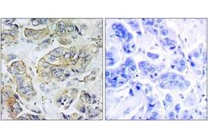 Immunohistochemistry analysis of paraffin-embedded human breast carcinoma tissue, using NPY5R Antibody.