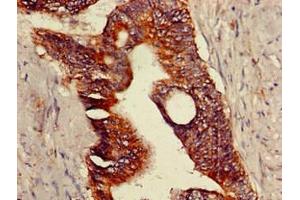 Immunohistochemistry of paraffin-embedded human colon cancer using ABIN7172875 at dilution of 1:100 (TRPV1 antibody  (AA 1-155))