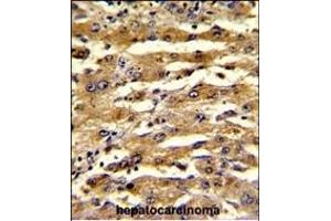 Formalin-fixed and paraffin-embedded human hepatocarcinoma with FABP3 Antibody (N-term), which was peroxidase-conjugated to the secondary antibody, followed by DAB staining. (FABP3 antibody  (N-Term))