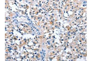 The image on the left is immunohistochemistry of paraffin-embedded Human thyroid cancer tissue using ABIN7128547(ASB2 Antibody) at dilution 1/50, on the right is treated with fusion protein. (ASB2 antibody)