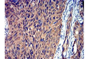 Immunohistochemical analysis of paraffin-embedded ROP1 tissues using cervical cancer mouse mAb with DAB staining. (ROP1 (AA 42-183) antibody)