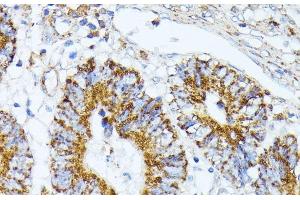 Immunohistochemistry of paraffin-embedded Human colon carcinoma using TRAP1 Polyclonal Antibody at dilution of 1:100 (40x lens). (TRAP1 antibody)