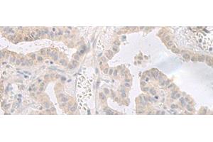 Immunohistochemistry of paraffin-embedded Human thyroid cancer tissue using GPRASP2 Polyclonal Antibody at dilution of 1:35(x200)
