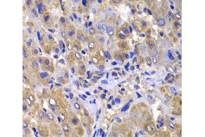 Immunohistochemistry of paraffin-embedded Human liver damage using CARD10 Polyclonal Antibody at dilution of 1:100 (40x lens). (CARD10 antibody)