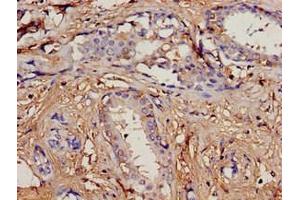 Immunohistochemistry analysis of human breast cancer using ABIN7164734 at dilution of 1:100 (PIP antibody  (AA 29-146))