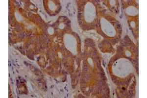 IHC image of ABIN7127772 diluted at 1:100 and staining in paraffin-embedded human colon cancer performed on a Leica BondTM system. (Recombinant PLGF antibody)