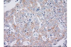 Immunohistochemical staining of paraffin-embedded Carcinoma of liver tissue using anti-KRT19mouse monoclonal antibody. (Cytokeratin 19 antibody  (AA 240-390))