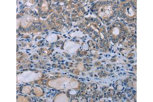Immunohistochemistry of Human thyroid cancer using HOMER1 Polyclonal Antibody at dilution of 1:50