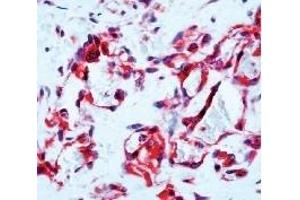 Formalin fixed paraffin embedded human angiosarcoma stained with Flt-1 antibody (FLT1 antibody  (C-Term))