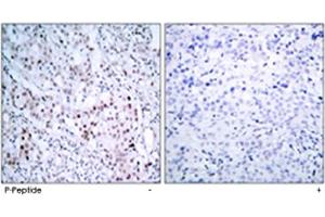 Immunohistochemical analysis of paraffin-embedded human breast carcinoma tissue using JUN (phospho S63) polyclonal antibody . (C-JUN antibody  (pSer63))