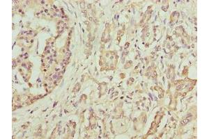 Immunohistochemistry of paraffin-embedded human pancreatic cancer using ABIN7145484 at dilution of 1:100 (DEFB129 antibody  (AA 20-183))