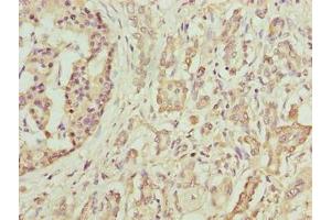Immunohistochemistry of paraffin-embedded human pancreatic cancer using ABIN7145484 at dilution of 1:100 (DEFB129 antibody  (AA 20-183))