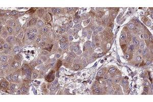 ABIN6276580 at 1/100 staining Human liver cancer tissue by IHC-P. (EpCAM antibody  (Internal Region))