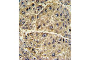 Formalin-fixed and paraffin-embedded human hepatocarcinoma with COL6A1 Antibody (N-term), which was peroxidase-conjugated to the secondary antibody, followed by DAB staining. (COL6A1 antibody  (N-Term))