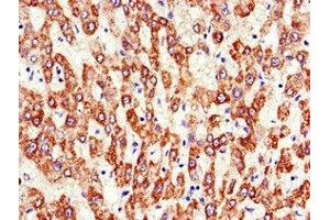 Immunohistochemistry of paraffin-embedded human liver cancer using ABIN7144836 at dilution of 1:100 (ATP5F1A (AA 59-257) antibody)