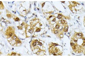 Immunohistochemistry of paraffin-embedded Human liver cancer using RRAGD Polyclonal Antibody at dilution of 1:100 (40x lens). (RRAGD antibody)