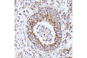 Immunohistochemistry of paraffin-embedded human colon carcinoma using DLAT antibody (ABIN7266768) at dilution of 1:100 (40x lens). (DLAT antibody  (AA 87-270))