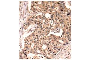 Immunohistochemistry of paraffin-embedded human breast carcinoma tissue, using Phospho-PXN-Y118 antibody (ABIN2987461). (Paxillin antibody  (pTyr118))