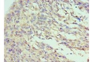 Immunohistochemistry of paraffin-embedded human cervical cancer using ABIN7156720 at dilution of 1:100 (Interleukin enhancer-binding factor 3 (ILF3) (AA 785-894) antibody)
