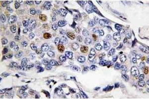 Immunohistochemistry (IHC) analyzes of POLR3A antibody in paraffin-embedded human breast carcinoma tissue. (POLR3A antibody)